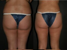 buttock augmentation before & after
