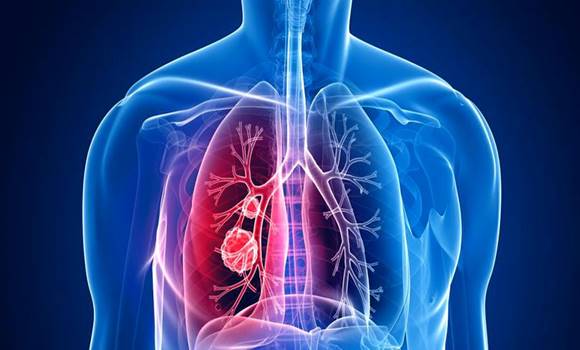 A tüdőrák figyelmeztető jelei, ami könnyen összetéveszthetőek egy makacs meghűléssel!