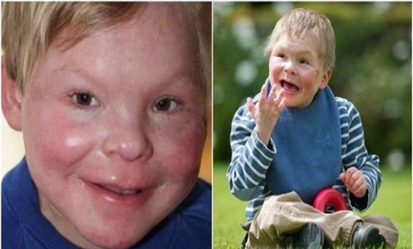 Ez a 13 éves fiú egy kisbaba testében rekedt egy különös genetikai rendellenesség miatt