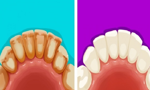 6 hatásos és természetes módszer a fogkő és a foltok eltüntetésére
