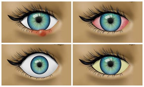 Ezekkel a tünetekkel próbál meg figyelmeztetni a szemed, hogy valami nincs rendben