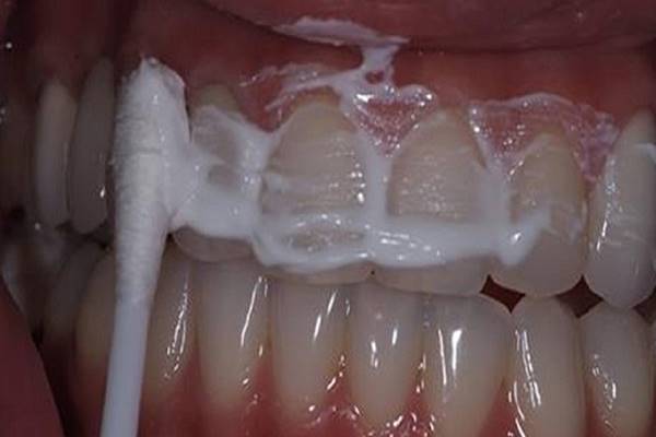 A barátnőm egy fogorvos felesége, megtanított 4 perc alatt kifehéríteni a fogaimat és megszabadulni a fogkőtől