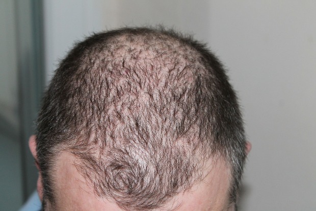 Döbbenetes fordulat kopaszság-ügyben 2 mm haj 6 nap alatt, elképesztő! 2