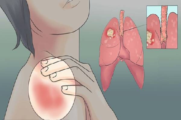 A női tüdőrák figyelmeztető jelei! Ne legyints rájuk!