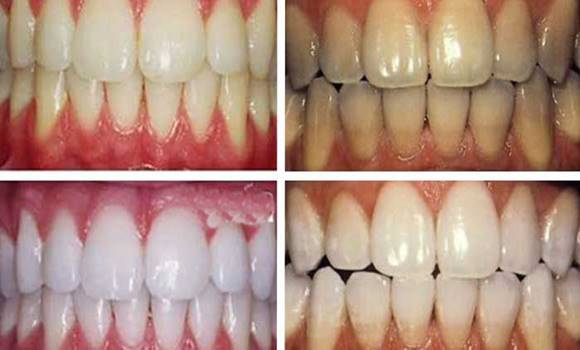 Próbáld ki a kurkumát fogfehérítésre, már az első mosás után 1-2 árnyalattal fehérebbek lesznek a fogaid!