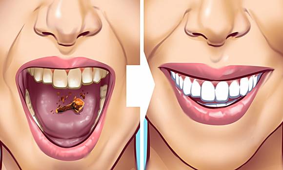 10 természetes gyógymód, amely segítségével könnyen megszabadulhatsz a fogkőtől!