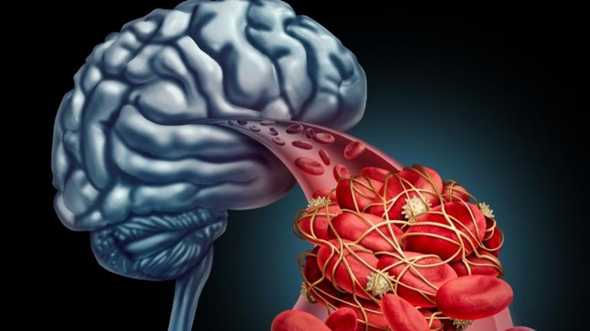 A koronavírus új tünete a stroke! A Covid-19 agyvérzést okozhat